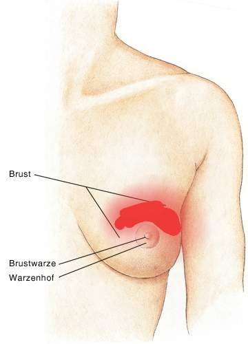 Verhartung In Der Linken Brust Keine Schmerzen Gesundheit Und Medizin Verhartung In Der Linken Brust Keine Schmerzen Gesundheit Und Medizin