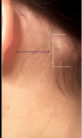 Verhartung Schmerzhaft Lymphknoten Verhartung Schmerzhaft Lymphknoten