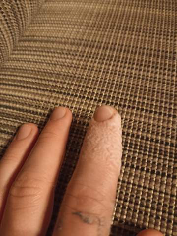 Verheilt mein Finger wieder normal?