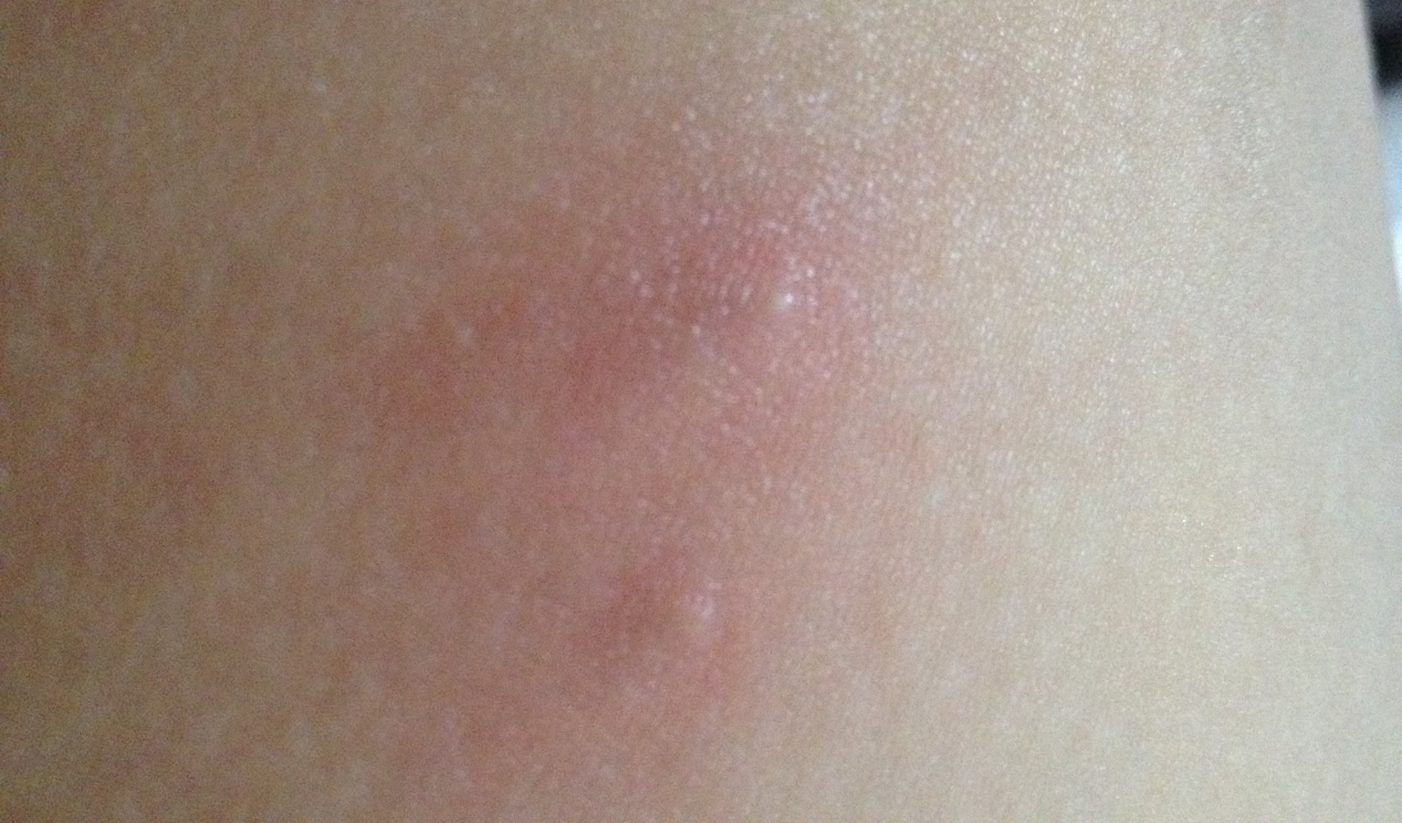 verknorppelte pickel im intimbereich?! (Gesundheit, Körper, Haut)