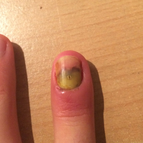 Mein Fingernagel nach 5 Wochen - (Medizin, Arzt, Fingernägel)