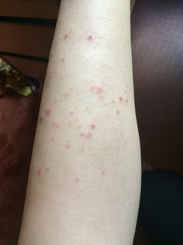 vernarbte beine durch eingewachsene