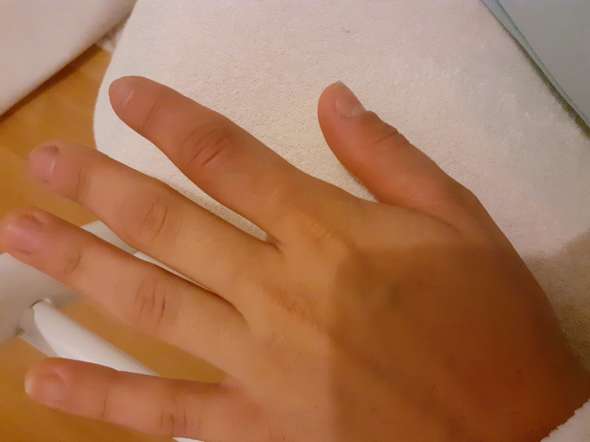 Verstaucht Oder Gebrochen Soll Ich Noch Ins Krankenhaus Bruch