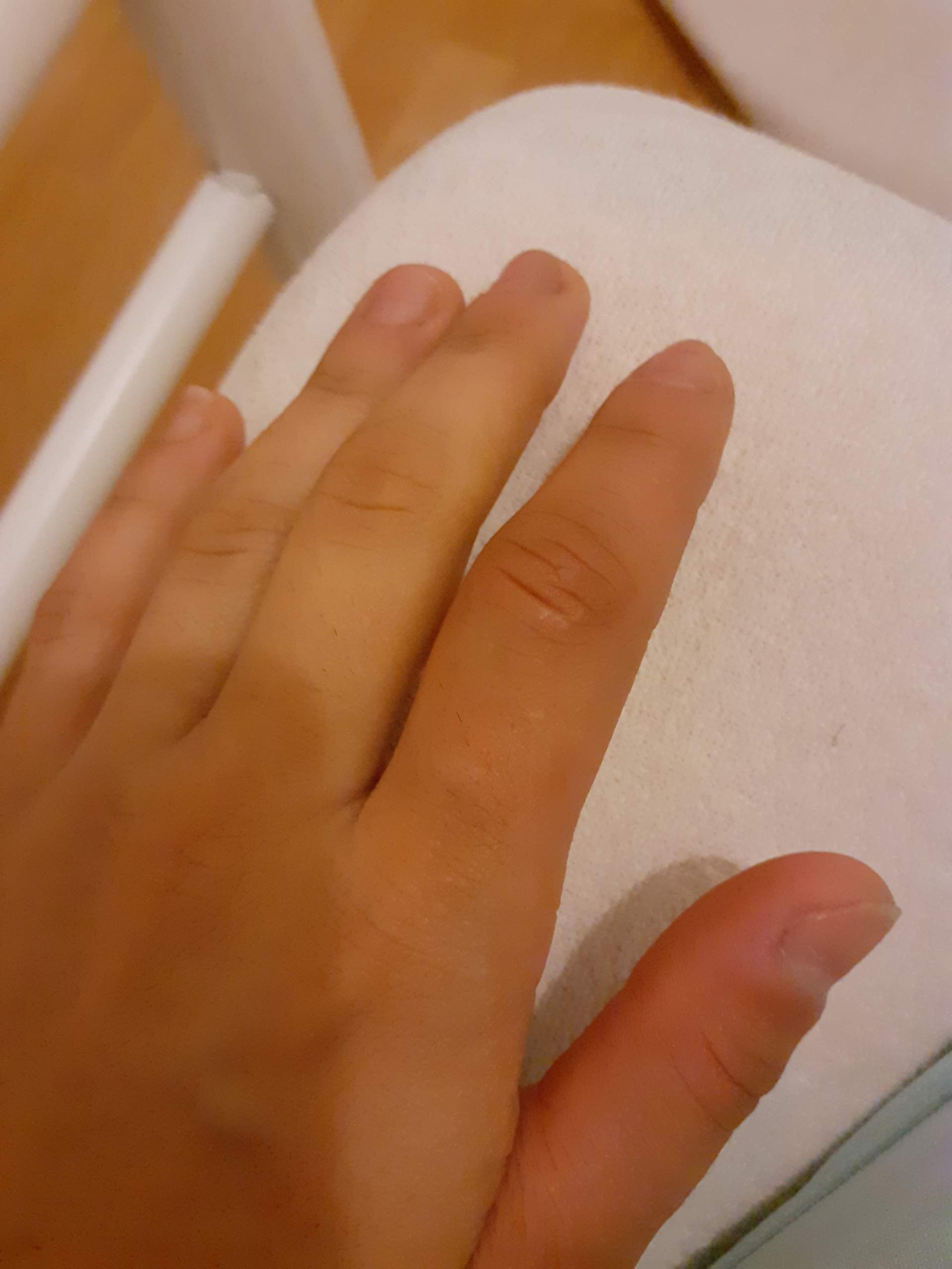 Finger In Autotür Eingeklemmt Wann Zum Arzt Verstaucht oder gebrochen soll ich noch ins krankenhaus:(? (Bruch)