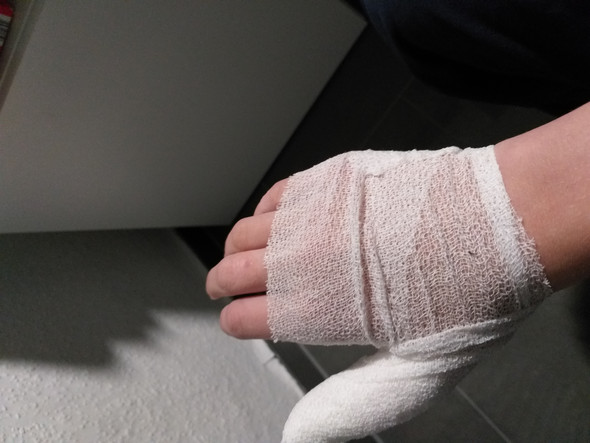 Verstauchten Daumen Zur Schule Gehen