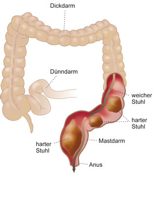 Verstopfung Im Mastdarm Was Hilft Wirklich Gesundheit Und Medizin Verstopfung Im Mastdarm Was Hilft Wirklich Gesundheit Und Medizin