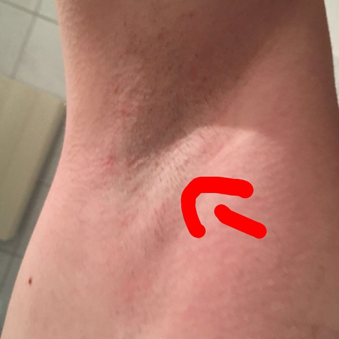 Verwölbung unter dem rechten Arm? (Arzt, Haut, Achsel)