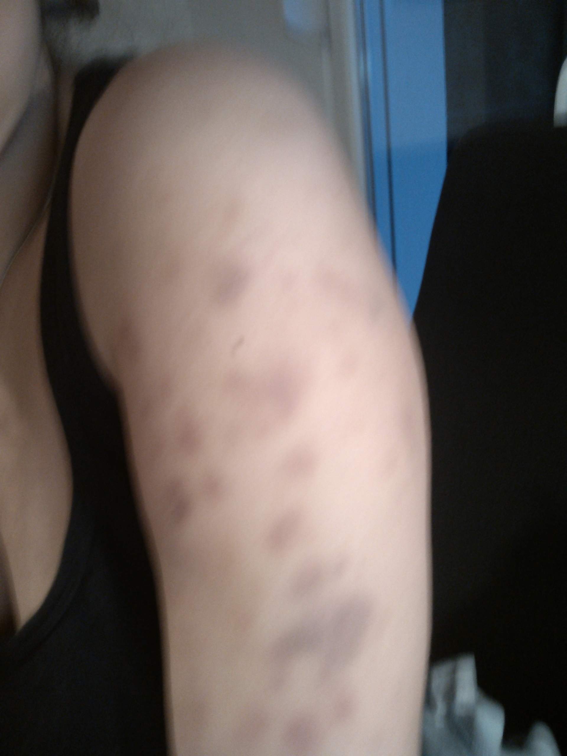 Viele blaue Flecken am Arm! ohne Grund? durch kratzen? HILFE Viele blaue Flecken am Arm! ohne Grund? durch kratzen? HILFE