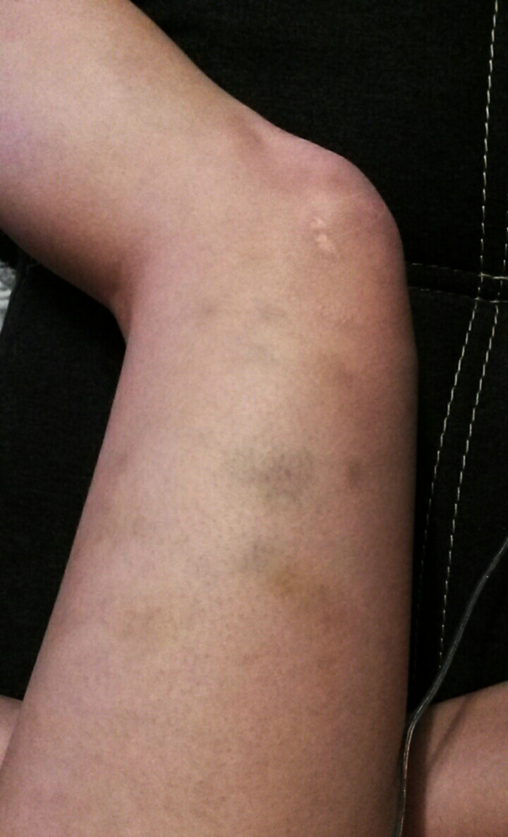 Viele blaue Flecken an den oberschenkeln.. Leukämie ? (Oberschenkel Viele blaue Flecken an den oberschenkeln.. Leukämie ? (Oberschenkel