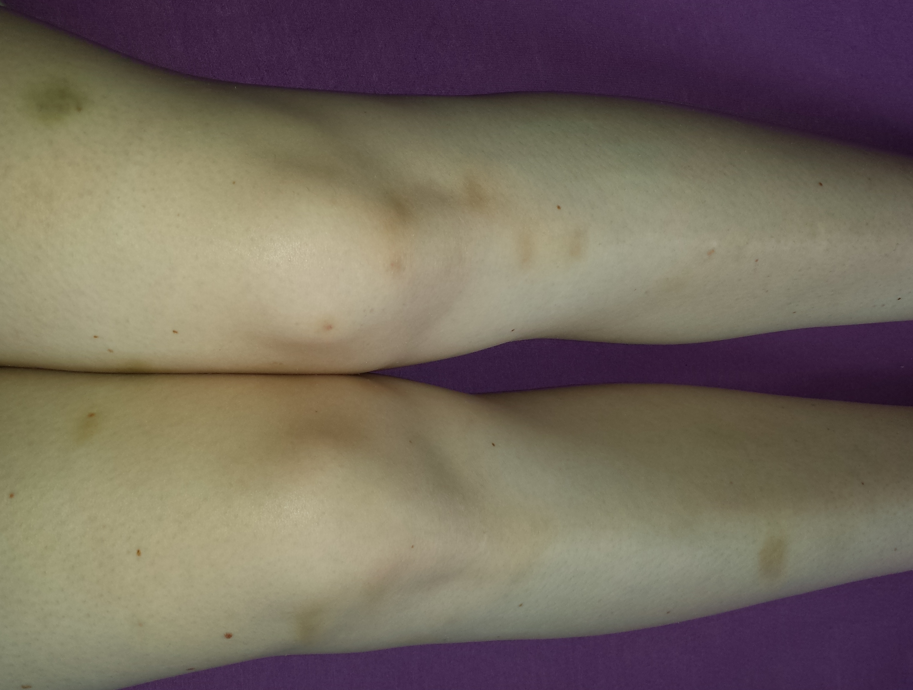 Viele Gelbe Flecke An Den Beinen Flecken Gelb Viele Gelbe Flecke An Den Beinen Flecken Gelb