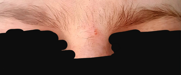 viele haare auf der nase normal