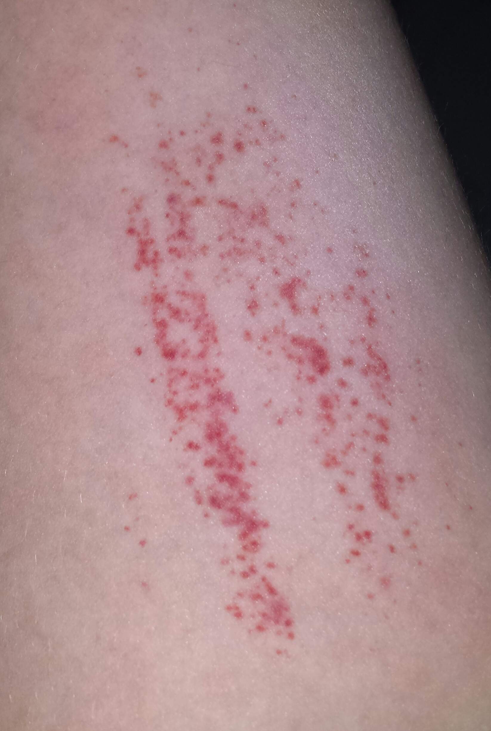 Viele kleine "Blutergüsse" nach Kratzen am Arm? Warum, was ist das
