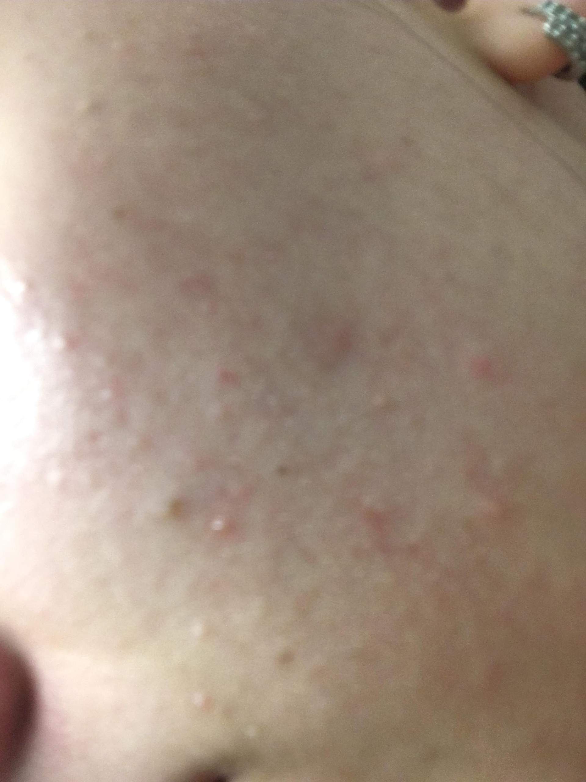 Viele kleine Pickel an der Wange? (Gesundheit und Medizin, Mädchen, Beauty) pickel auf der wange loswerden