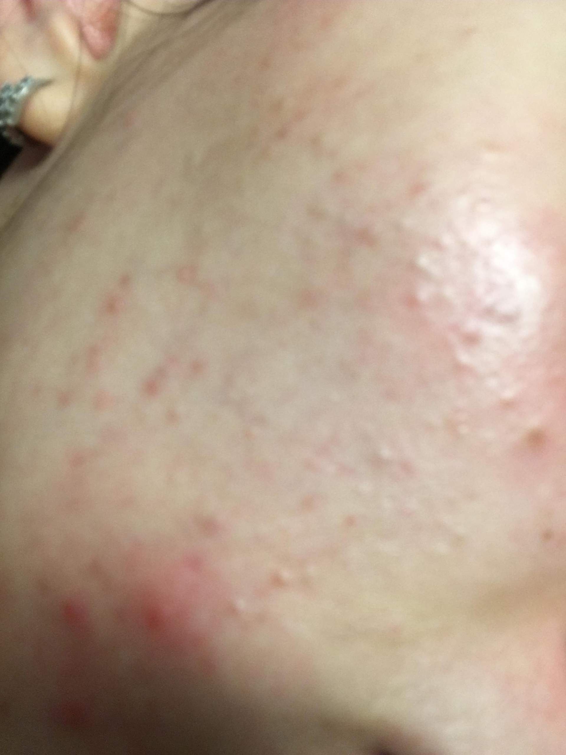 pickel auf der wange loswerden pickel auf der wange loswerden