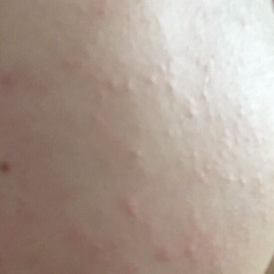 Viele kleine Pickel an Wange? (Gesundheit und Medizin, Haut, Pflege) pickel auf der wange loswerden