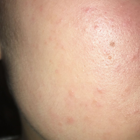 Viele Kleine Pickel An Wange Gesundheit Und Medizin Haut Pflege