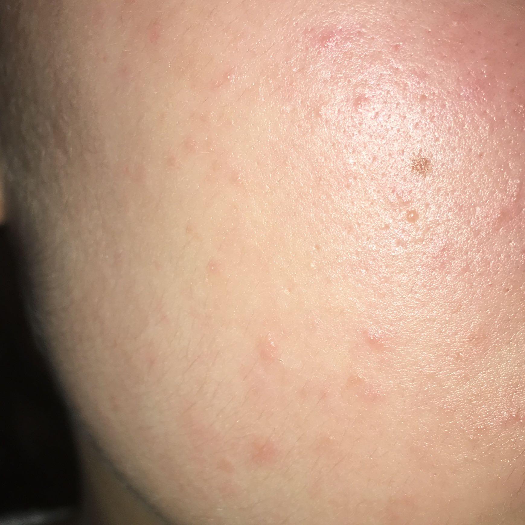 Viele kleine Pickel an Wange? (Gesundheit und Medizin, Haut, Pflege)