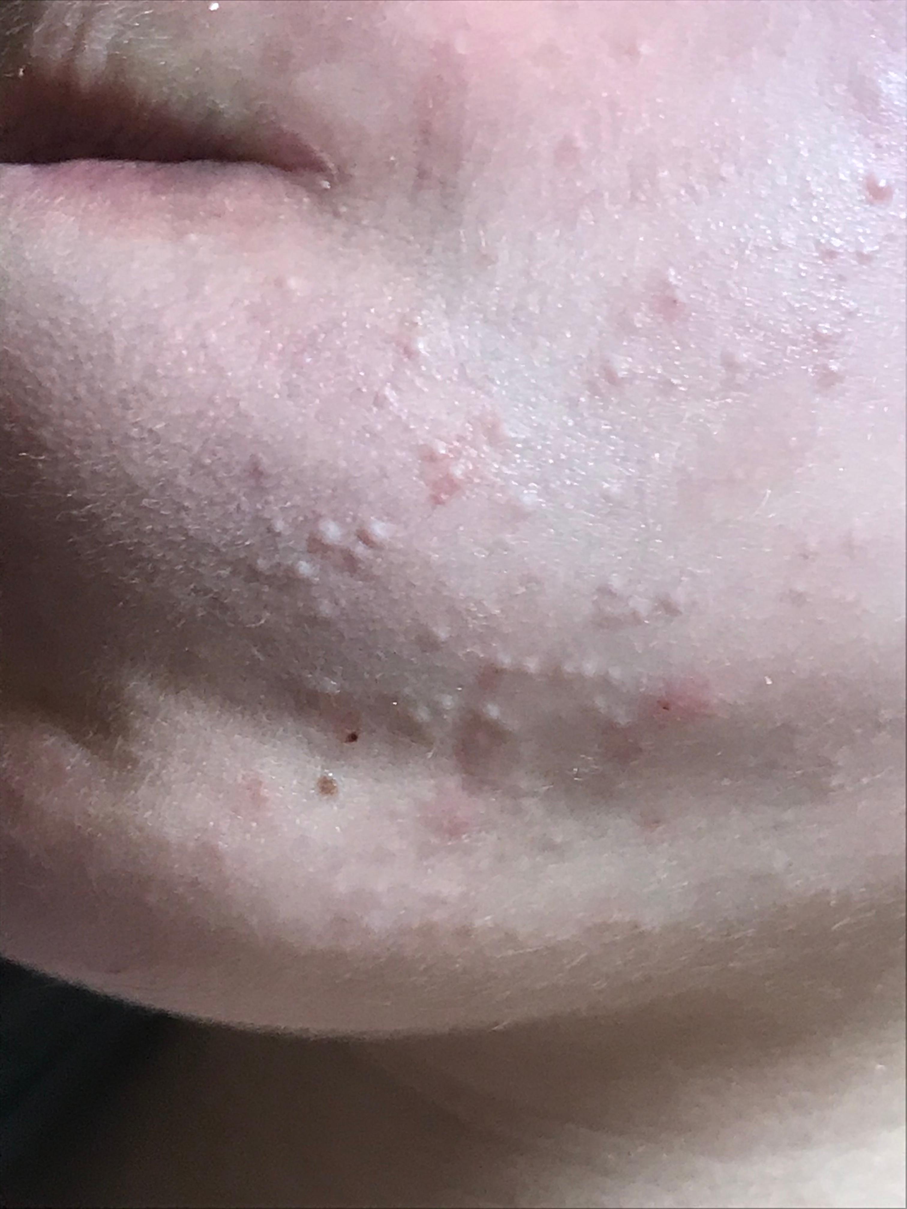 pickel gesicht pickel gesicht