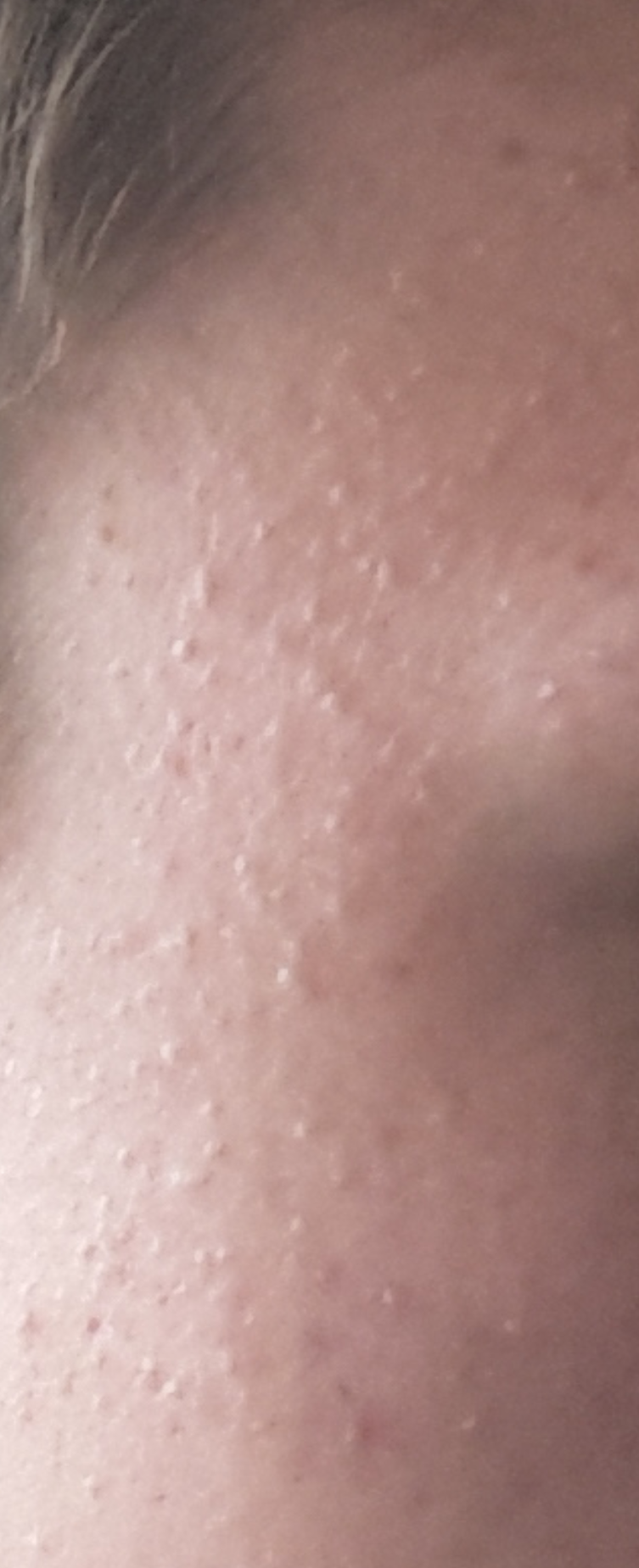 pickel auf den schultern pickel auf den schultern