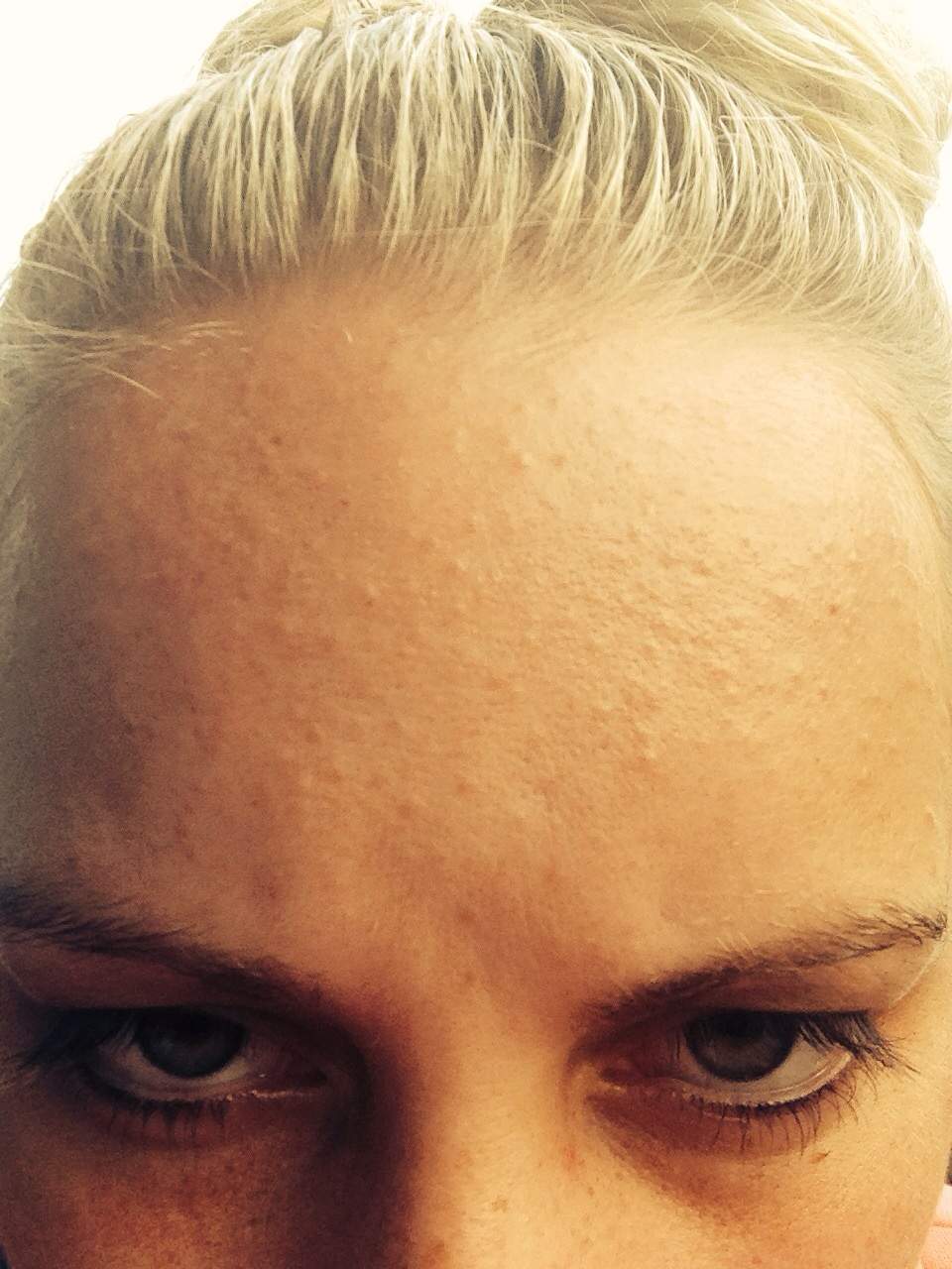 Viele Kleine Pickelchen Im Gesicht Pickel Unreinheiten Viele Kleine Pickelchen Im Gesicht Pickel Unreinheiten