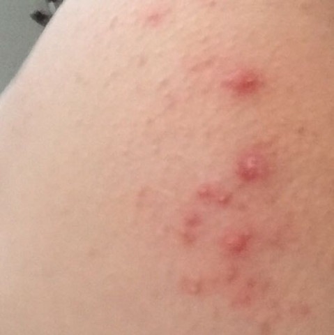 Viele Pickel An Einer Stelle Am Po Woran Liegt Es Gesundheit Und Medizin Popo Viele Pickel An Einer Stelle Am Po Woran Liegt Es Gesundheit Und Medizin Popo
