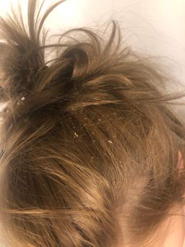 Viele Schuppen Was Tun Computer Gesundheit Und Medizin Haare Viele Schuppen Was Tun Computer Gesundheit Und Medizin Haare