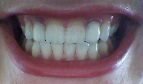 Zwei Frontkronen - (Zähne, Zahnarzt, Krone)
