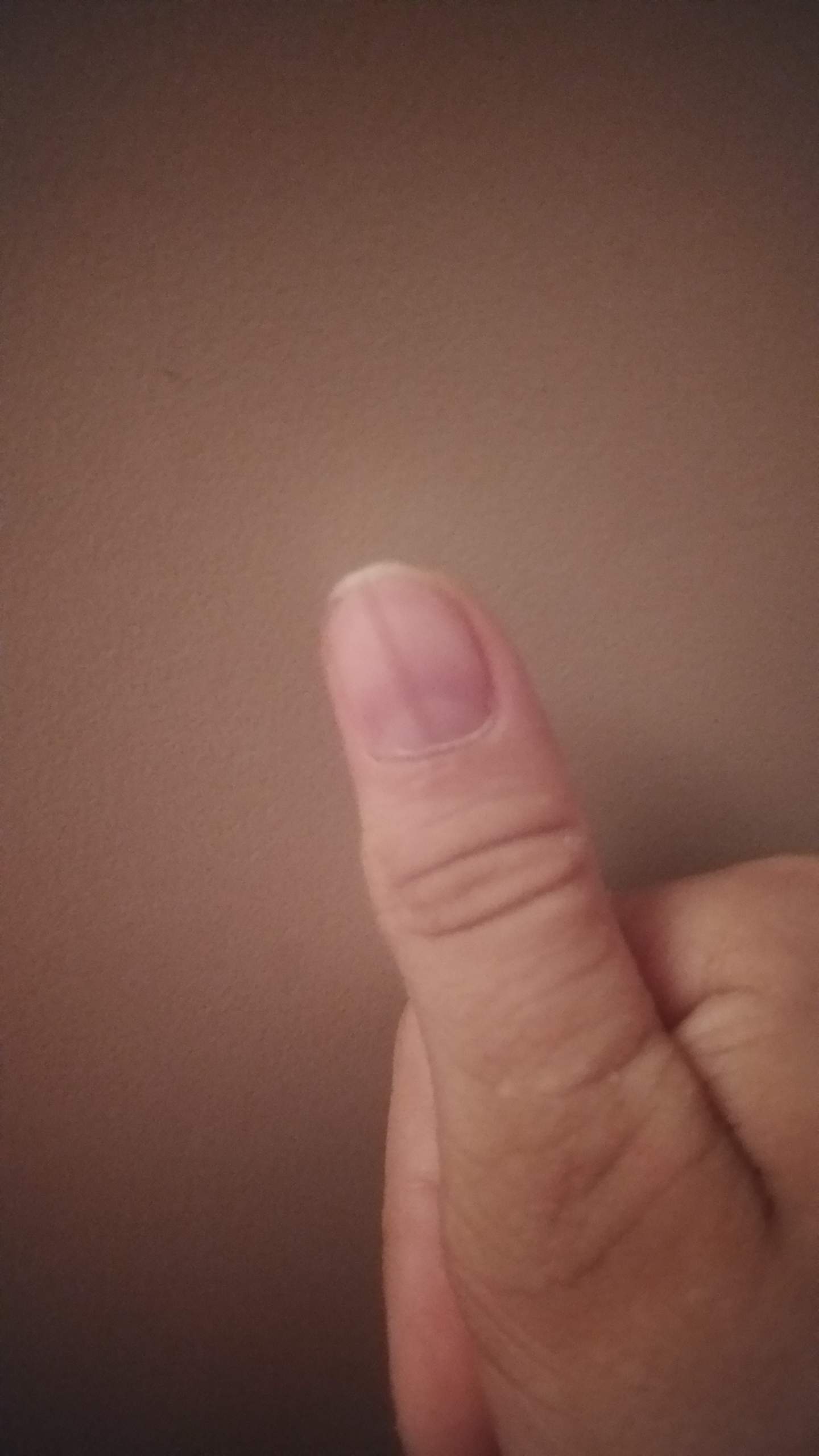 Vom Nagelbett Ausgehender Strich Im Daumennagel Nagel Hautkrebs Vom Nagelbett Ausgehender Strich Im Daumennagel Nagel Hautkrebs