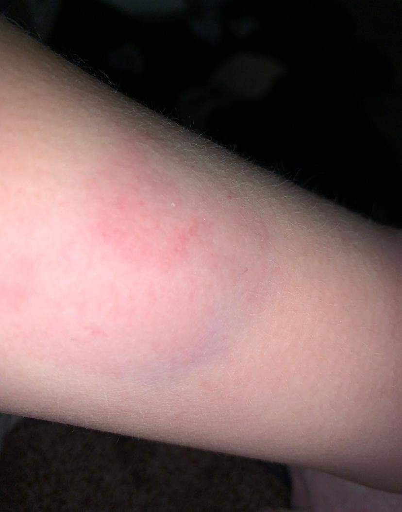 Vom Pferd gebissen? (Reiten, Biss)