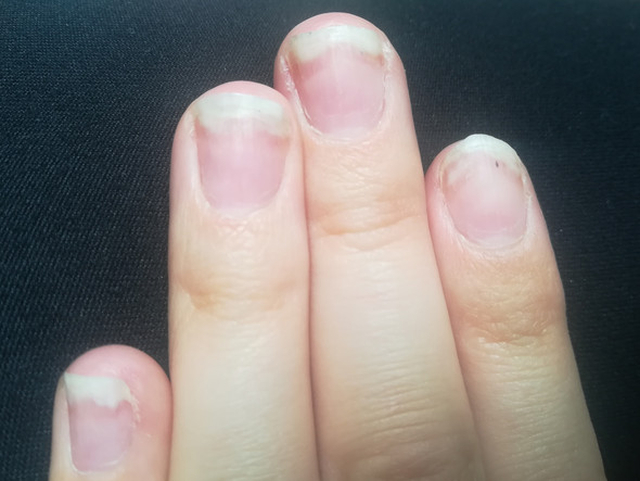 Von Was Konnte Das Kommen Fingernagel Manikure Von Was Konnte Das Kommen Fingernagel Manikure