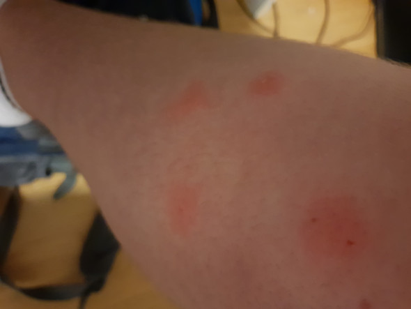 Von Was Wurde Ich Gebissen Insekten Biss