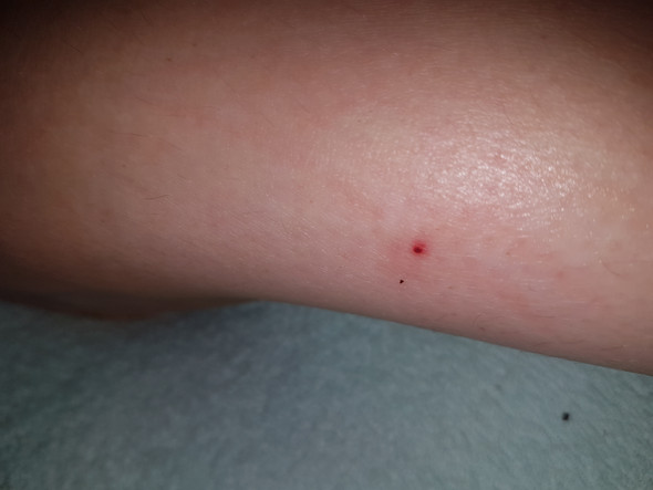 Insektenstich - die meistgelesenen Fragen