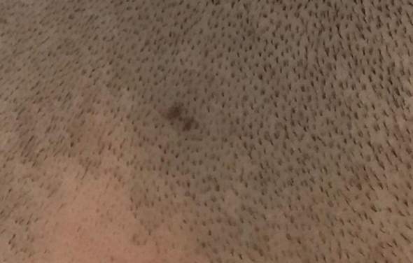 Vor 2 en Bei Rasur Leicht Geschnitten Werden Die Haare An Dieser Stelle Nicht Mehr Wachsen Gesundheit Und Medizin Haut Frisur