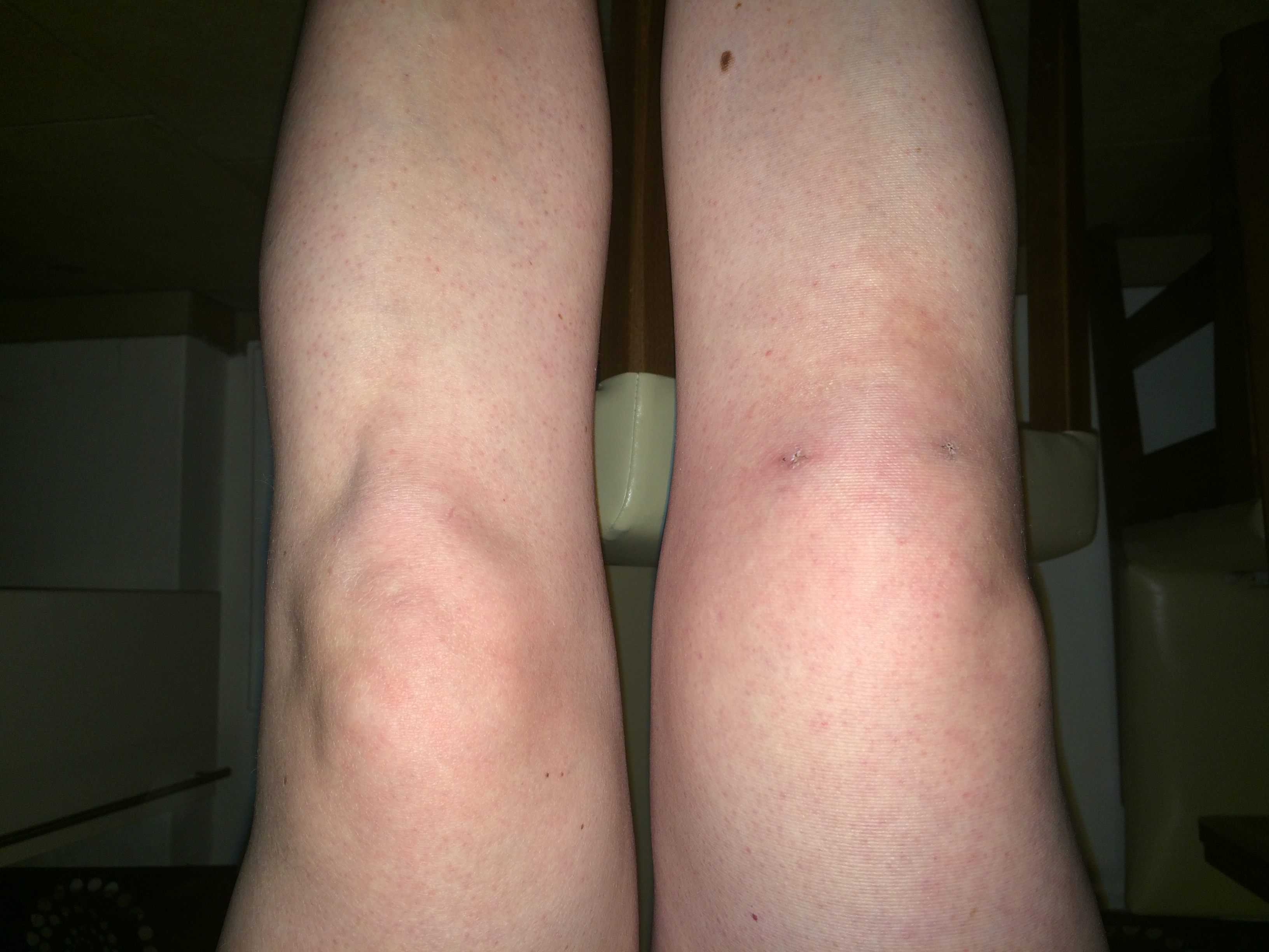 Vor Vier Wochen Kniespiegelung Ist Es Normal Dass Das Knie Immer Noch Nicht Voll Beweglich Ist Und Anschwillt Gesundheit Medizin Vor Vier Wochen Kniespiegelung Ist Es Normal Dass Das Knie Immer Noch Nicht Voll Beweglich Ist Und Anschwillt Gesundheit Medizin