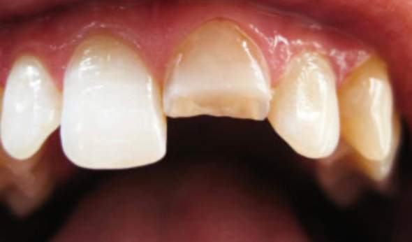 Vorderer Zahn In Der Mitte Gebrochen Zahne Zahnkrone