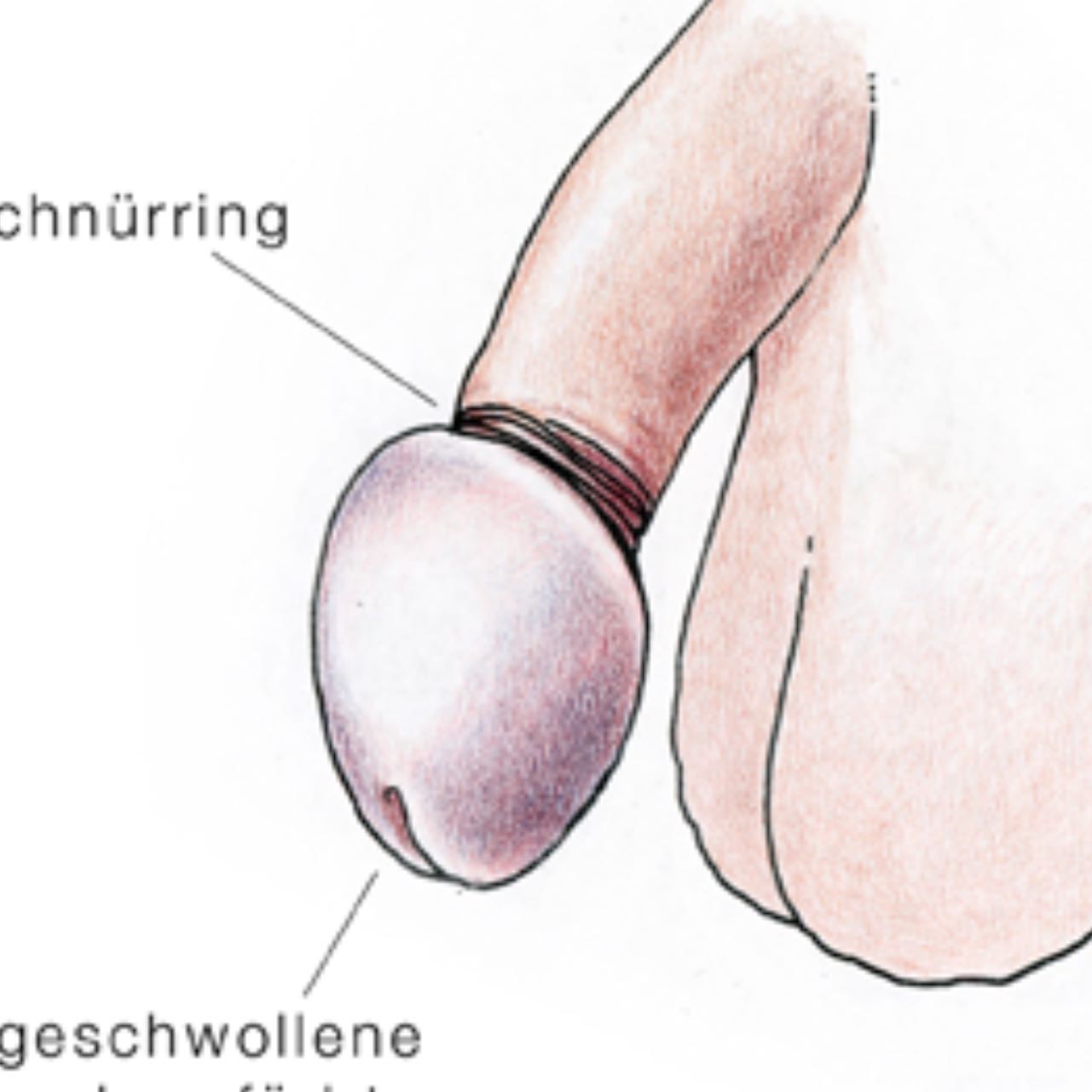zu kurzer penis