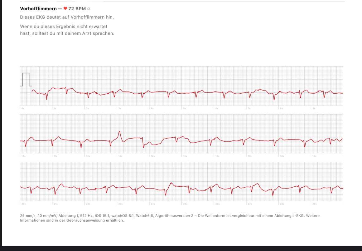 Vorhofflimmern Apple Watch EKG? (Herz, EKG Befund)