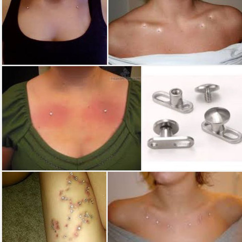 Anzeichen rauswachsen dermal anchor Dermal Anchor: