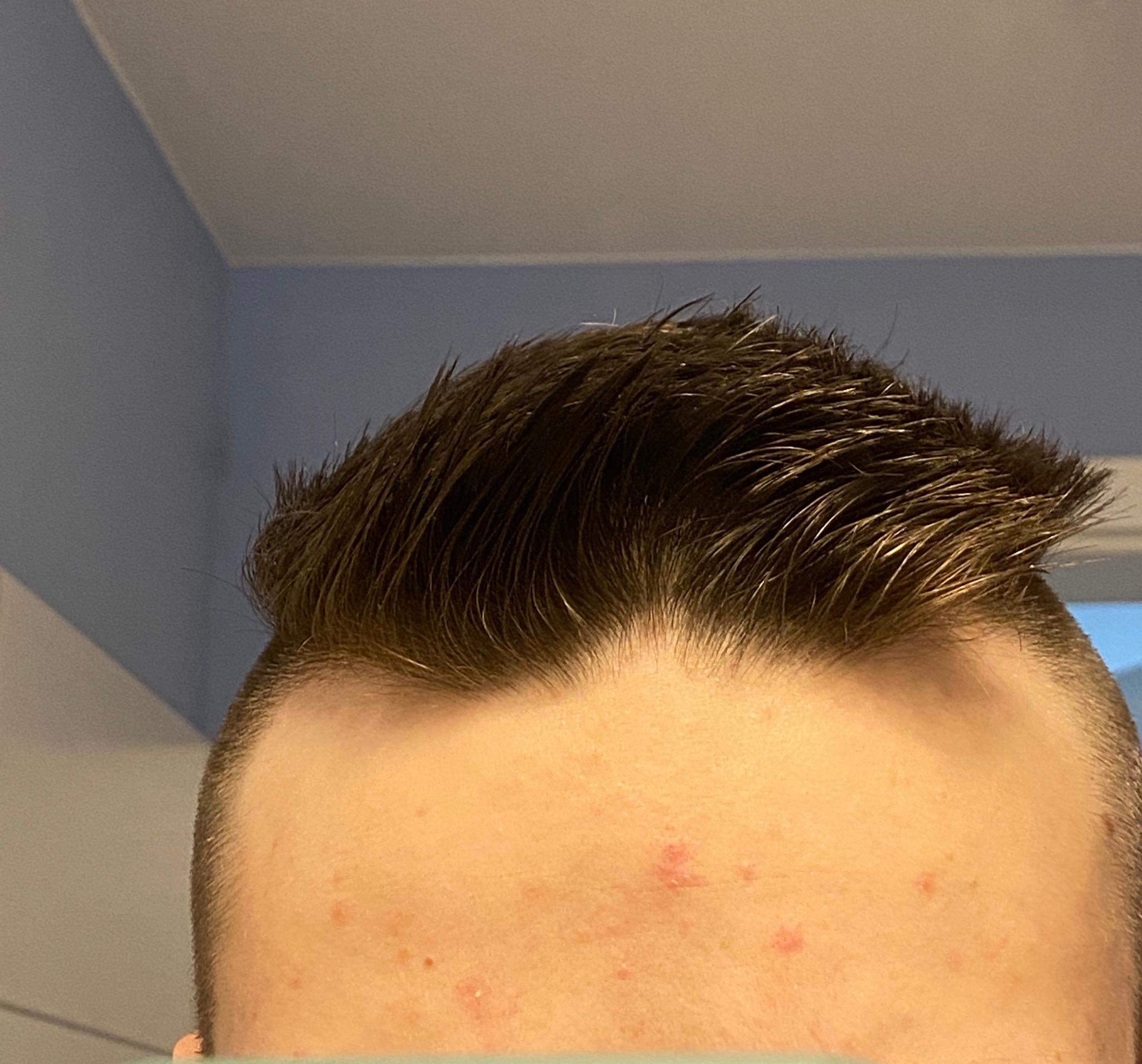 Vitamin D3 Haare Wachsen Wieder