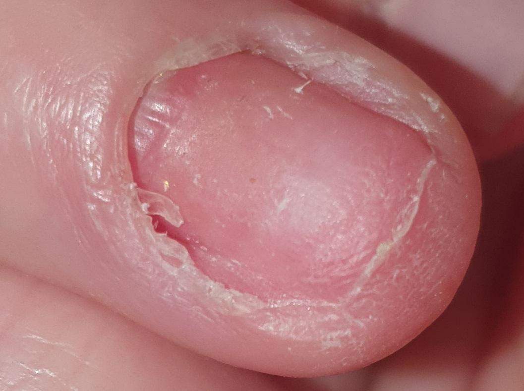 Wächst da ein Nagel nach? (Gesundheit und Medizin, Nägel, Fingernägel) Wächst da ein Nagel nach? (Gesundheit und Medizin, Nägel, Fingernägel)