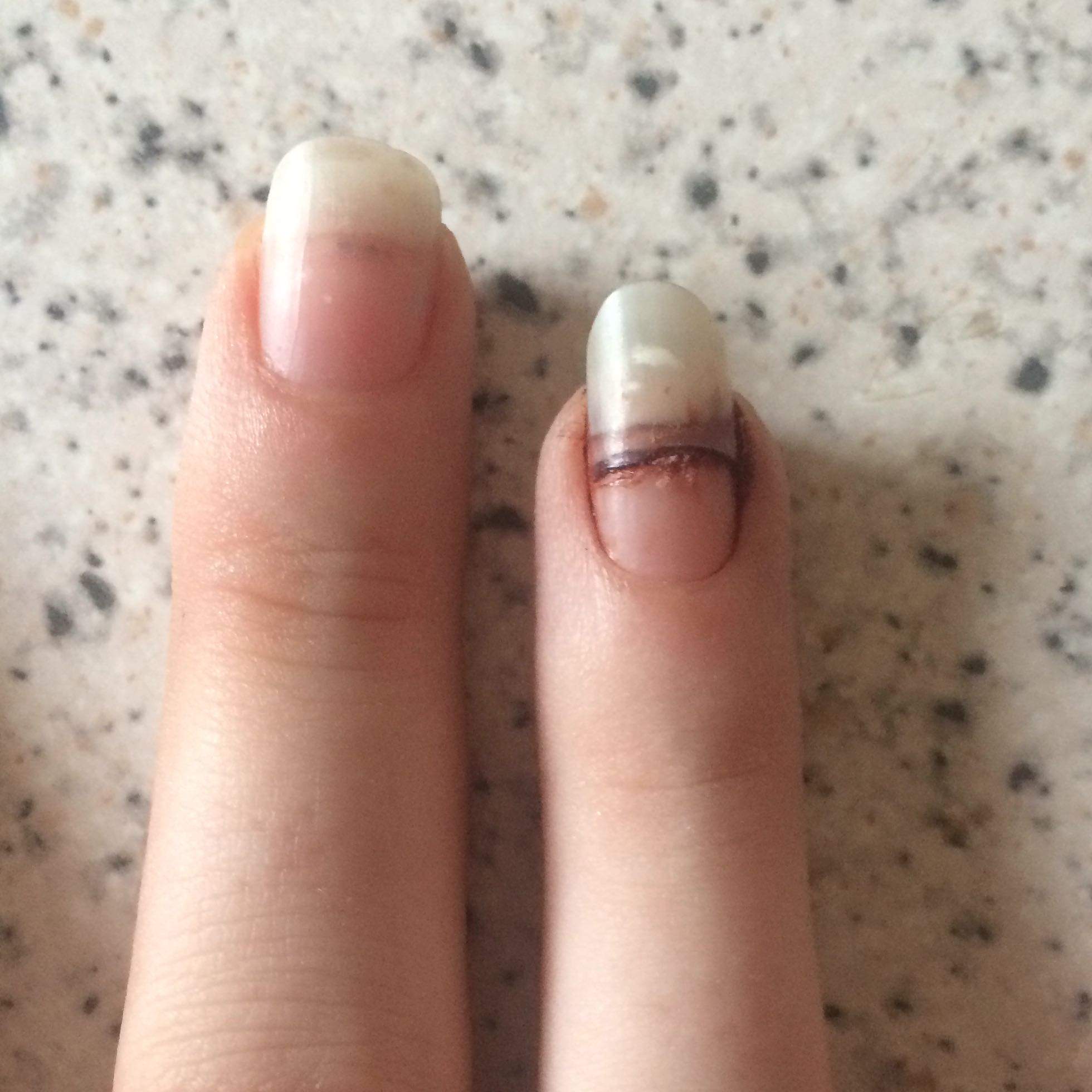 Wächst das Nagelbett wieder nach? Was kann ich machen? (Beauty, Nägel, Orthopäde)