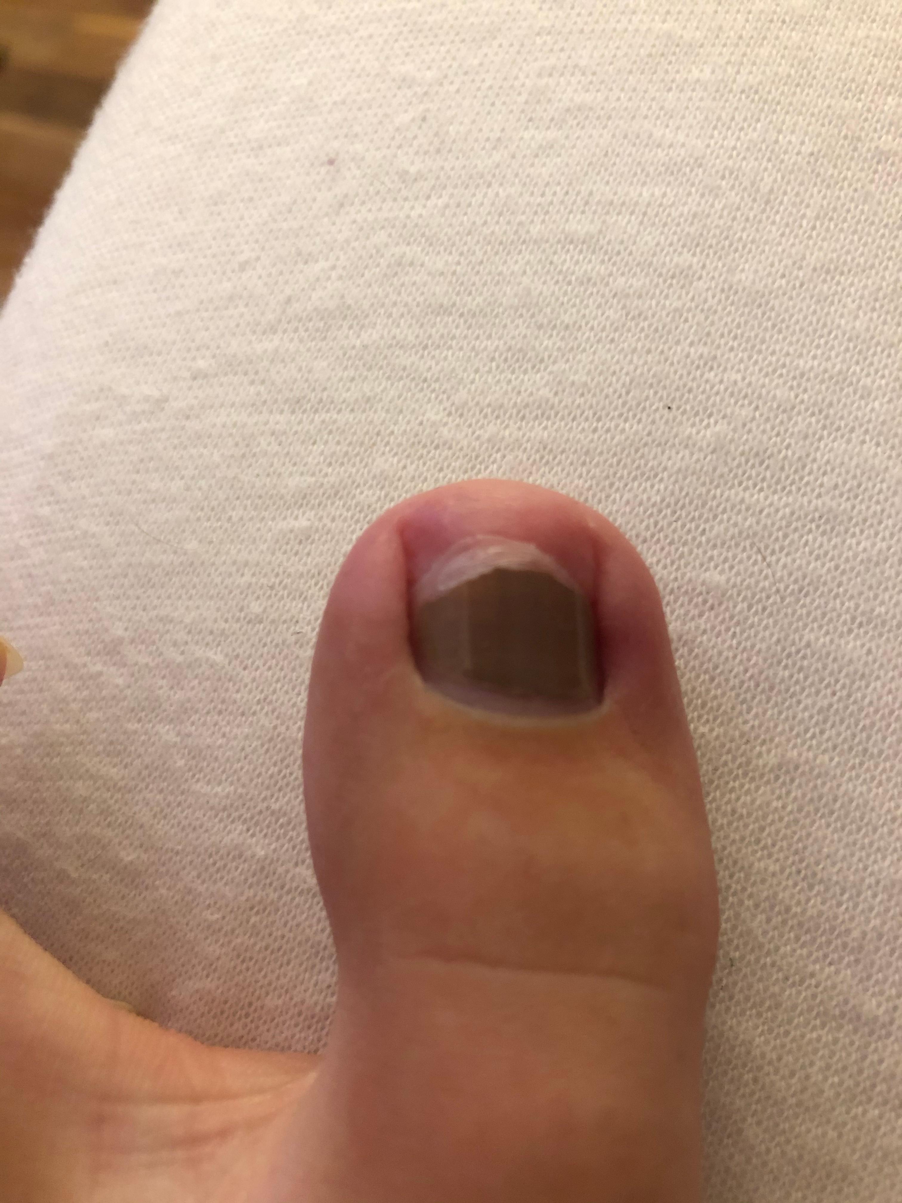 Wachst Der Eingewachsene Nagel Wieder Gerade Gesundheit Und Medizin Gesundheit Nagel Wachst Der Eingewachsene Nagel Wieder Gerade Gesundheit Und Medizin Gesundheit Nagel