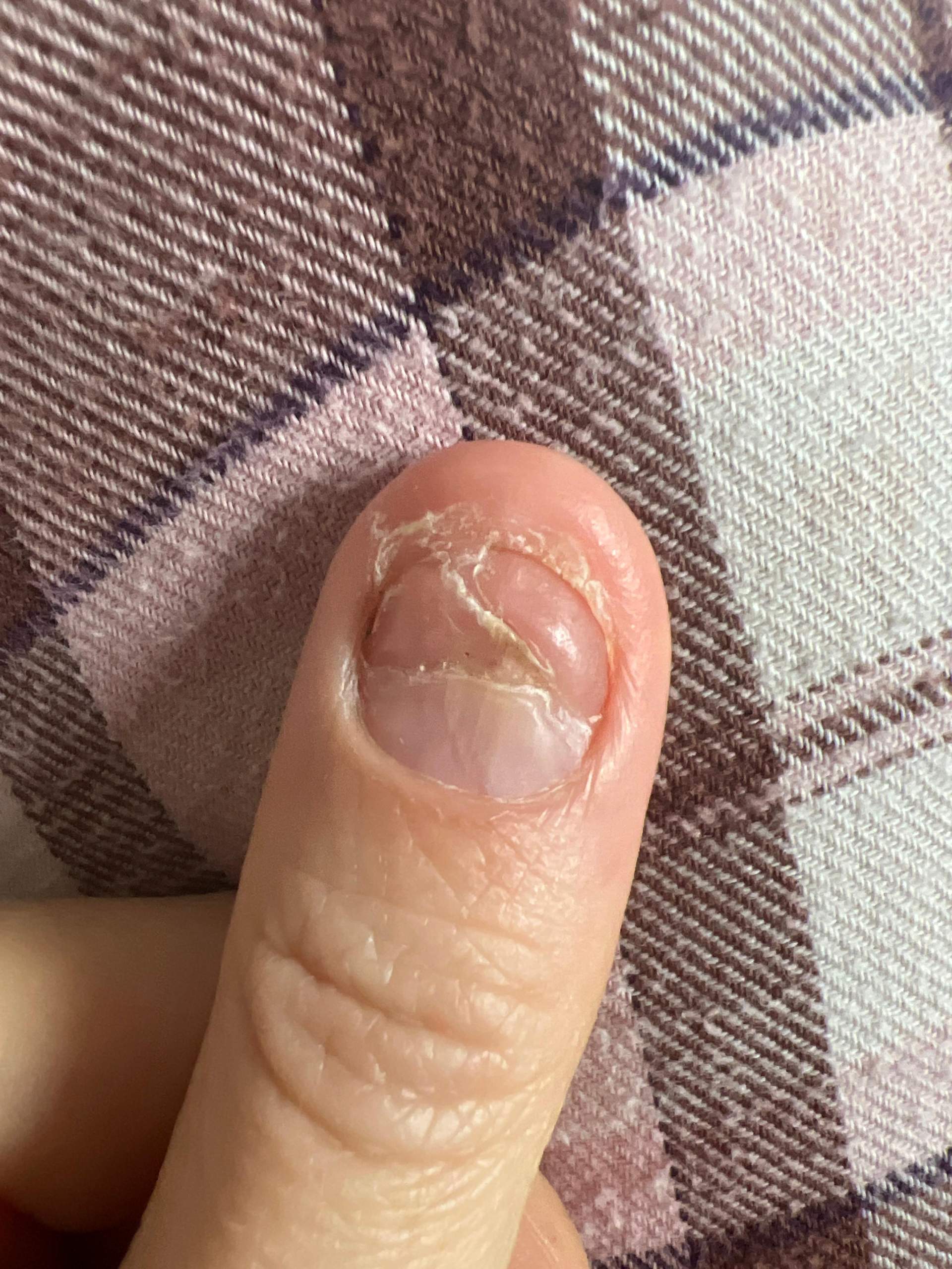 Wächst der Nagel normal nach? (Nägel, Fingernägel)