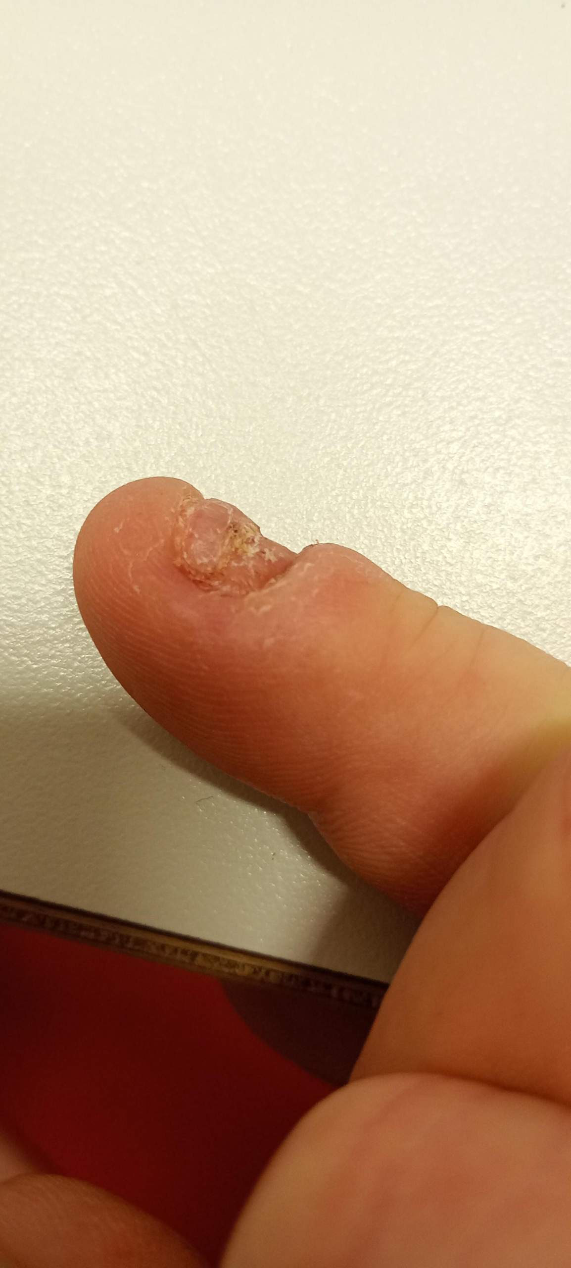 Wächst der Nagel wieder nach wegen vorne? (Nägel, Fingernägel, Heilung)
