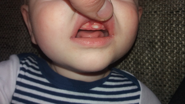 Wachst Der Zahn Normal Zahne Baby