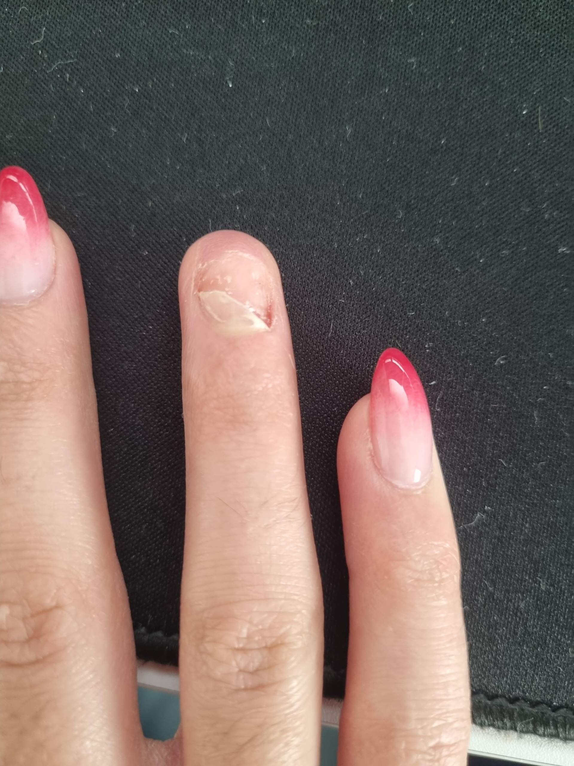 Nagel Komplett Abgerissen Wächst Er Nach Wächst ein Fingernagel wieder komplett nach? (Nägel, Finger, Fingernägel)