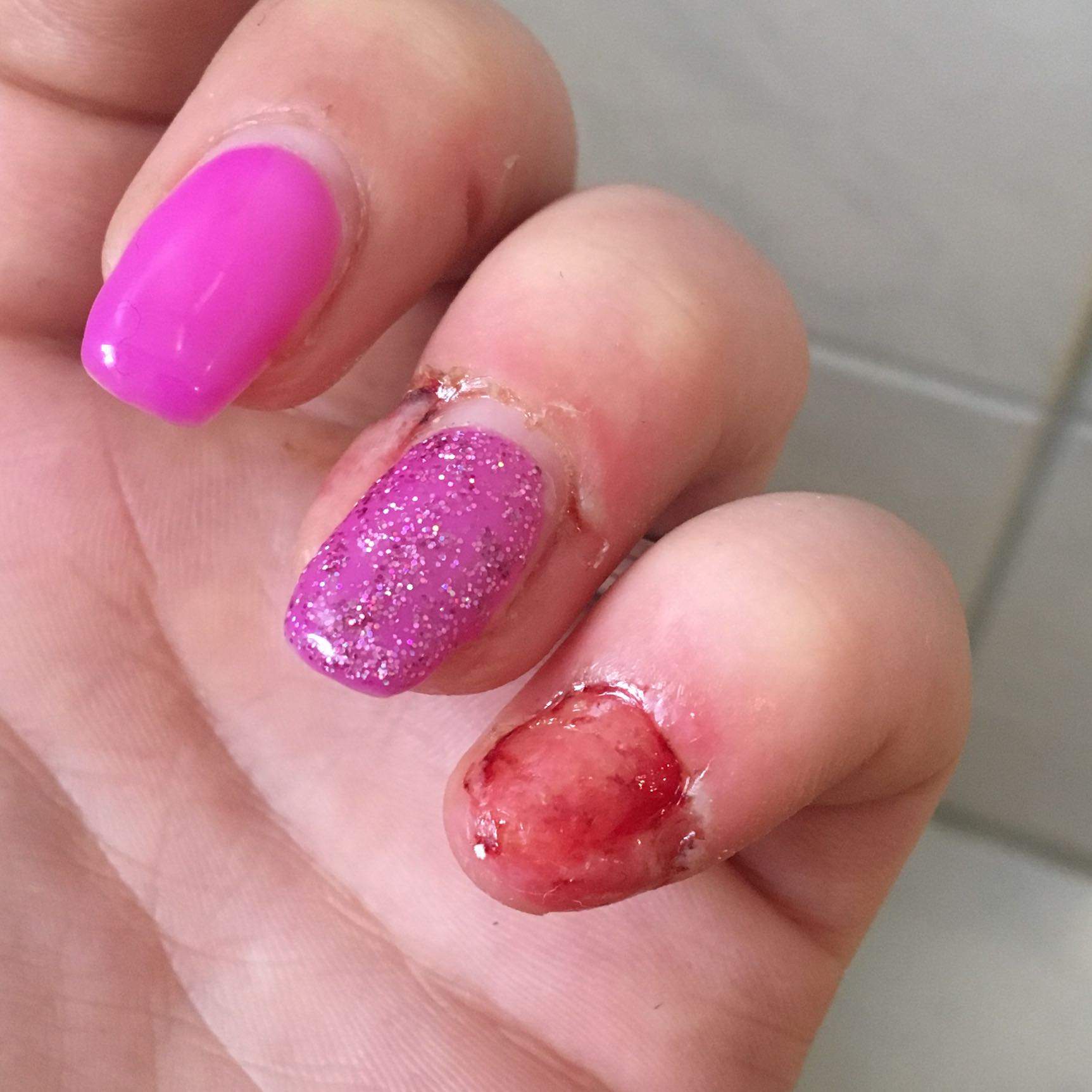 wachst mein fingernagel wieder nach wenn er komplett abgerissen ist gesundheit und medizin fingernagel verletzt