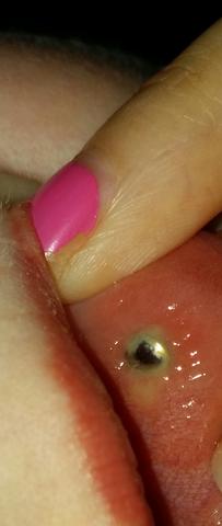 wachst mein madonna piercing ein lippe schwellung eingewachsen