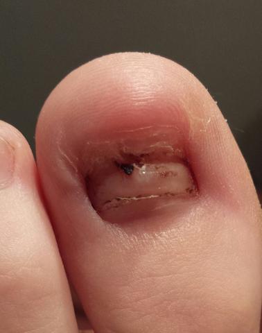 Wachst Mein Zehnagel Wieder Normal Nach Gesundheit Fusse Fussnagel Wachst Mein Zehnagel Wieder Normal Nach Gesundheit Fusse Fussnagel