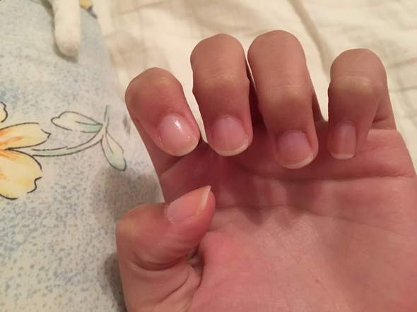 Wächst Nagelbett nach langem Nagelkauen wieder? (Gesundheit und Medizin